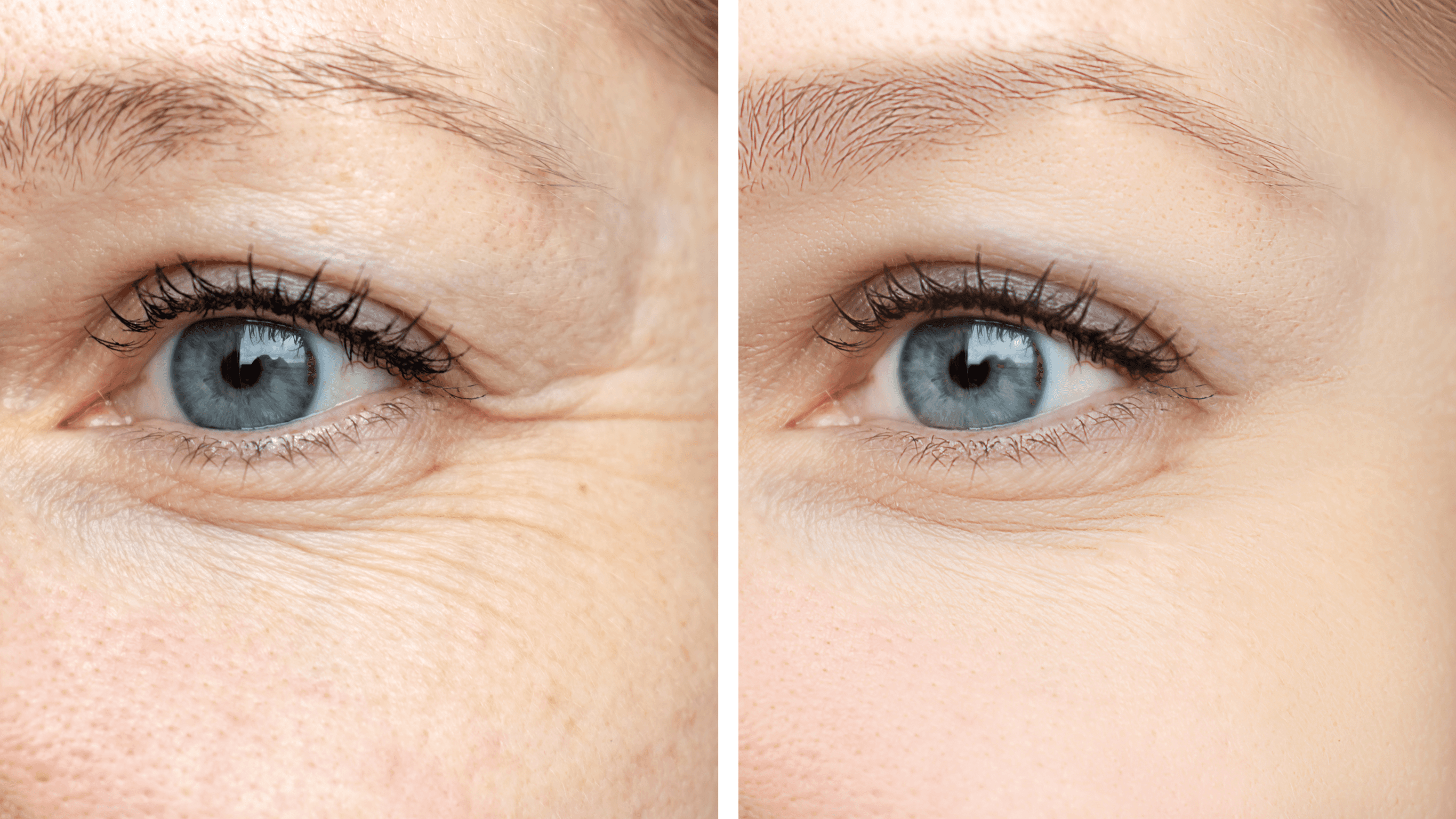 Wrinkles before and after treatment