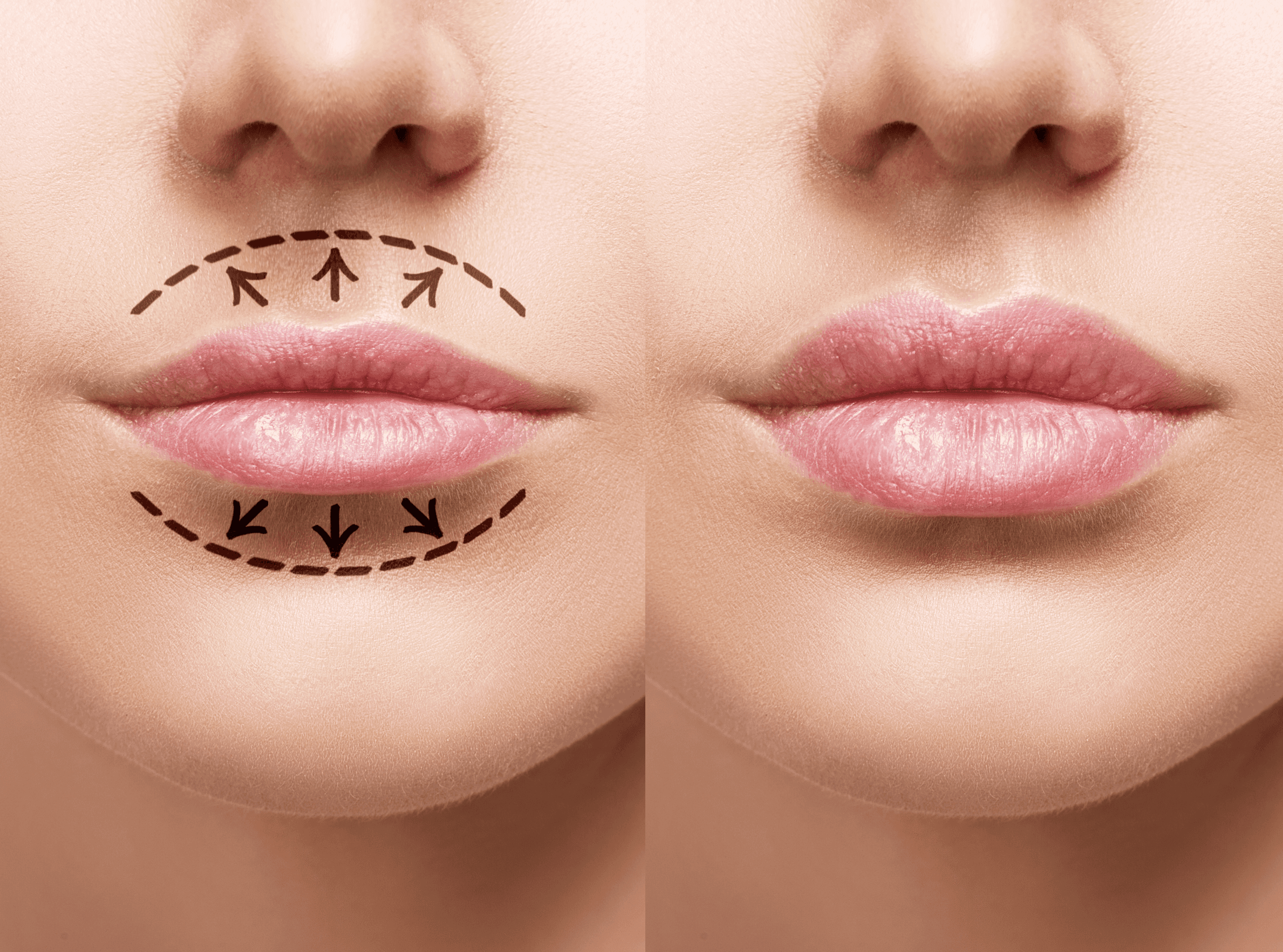 Lip Augmentation